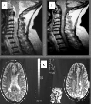 A. Imagen sagital del estudio RM-T2 raquídea: se observan datos de cervicoartrosis y área de hiperseñal medular a la altura de C2. B. Imagen sagital del estudio de RM-T2 a los 4 años: aparecen nuevas hiperseñales medulares cervicales. C. Imagen axial del estudio de RM-T2 cerebral: múltiples áreas de hiperseñal en la sustancia blanca periventricular y de centros semiovales.