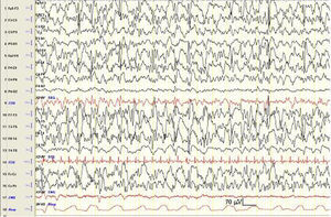 EEG-poligráfico en el que se objetiva una desorganización de la actividad cerebral de fondo junto con la presencia de paroxismos multifocales/difusos de ondas agudas y punta-onda lenta, de mayor amplitud en regiones anteriores. Constante de tiempo: 0,3s. Filtro de altas frecuencias: 35Hz.