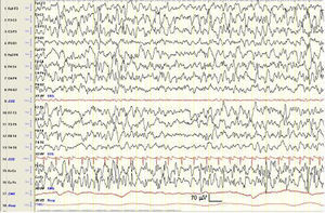 EEG-poligráfico tras varios meses de tratamiento en el que se objetiva una mejoría en la actividad bioeléctrica cerebral de fondo, así como una disminución en la amplitud y persistencia de las anomalías epileptiformes. Constante de tiempo: 0,3s. Filtro de altas frecuencias: 35Hz.