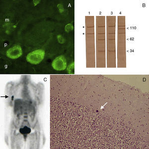 A) Sección de cerebelo de rata incubada con el suero de la paciente, dilución 1:250, y desarrollado mediante inmunofluorescencia (M: capa molecular; P: capa de células de Purkinje; G: capa granular) (x400). B) Inmunoblot de extractos de cerebelo de rata incubado con el suero (1:500) de: 1, control sano; 2, paciente actual; 3, paciente control con anticuerpos anti-Yo (cortesía del Dr Francesc Graus); 4, otro paciente con degeneración cerebelosa subaguda no asociada a cáncer y anticuerpos frente a una proteína desconocida de 110 kd. Los arteriscos indican reactividades inespecíficas. C) PET corporal total con fluorodesoxiglucosa. D) Sección del cerebelo de la autopsia de la paciente teñido mediante hematoxilina-eosina. La flecha indica la presencia de un «torpedo» (x100).