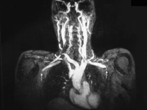 Angio-RMN de troncos supraaórticos: oclusión-estenosis bilateral de arterias subclavias (flechas blancas).