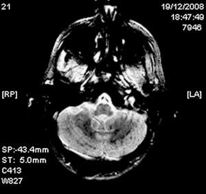RM cerebral (secuencia eco de gradiente, corte axial). Hipointensidades puntiformes en ambos hemisferios cerebelosos compatibles con microhemorragias.