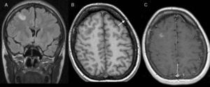 RM cerebral donde se aprecia hiperintensidad de señal FLAIR (A) localizada en la sustancia gris de la circunvolución frontal media derecha. En secuencias EG 3D potenciadas en T1 (B) se aprecia una lesión hipointensa que se realza tras la administración de gadolinio en la secuencia SE ponderada en T1 (C).