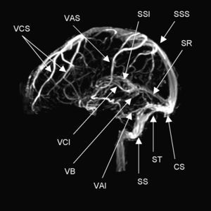 Anatomía normal de los principales senos venosos en imagen por resonancia magnética en fase venosa. CS: confluencia de los senos (presa de Herófilo); VAI: vena anastomótica inferior (de Labbé); VAS: vena anastomótica superior (de Trolard); VB: vena basal (de Rosenthal); VCI: vena cerebral interna (de Galeno); VCS: venas cerebrales superficiales; SR: seno recto;SS: seno sigmoideo; SSI: seno sagital inferior; SSS: seno sagital superior; ST: seno transverso o lateral.