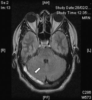 IRM en secuencia FLAIR plano axial que muestra hiperintensidad en el trayecto del ST derecho que corresponde a trombosis (flecha).