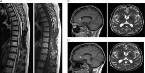 A) RM sagital T2 y sagital T1: entre el segmento D9 y D10 existe una lesión de 1cm situada en la región posterolateral derecha de la médula, indicativa de depósito de melanina. B) RM sagital T1 y axial T2: imágenes indicativas de implantes ependimarios en ambas astas anteriores de de ventrículos laterales. C) RM sagital T1 y axial T2: aumento de tamaño de los implantes ependimarios.