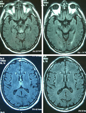 Imagen FLAIR axial correspondiente al paciente 4 que muestra la típica hiperintensidad de señal periacueductal y talámica (izquierda), con clara mejoría en la RM de control (derecha).