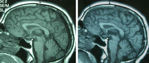 Imagen T1 sagital del mismo paciente, inicial y a los 9 meses, que muestra la atrofia de los cuerpos mamilares (flecha).