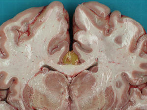 Corte coronal del cerebro en fresco a nivel de los núcleos de la base. Se observa lipoma interhemisférico situado en la parte anterior del cuerpo calloso.
