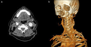 AngioTC cervical. Corte axial en lado izquierdo (a) y su reconstrucción en 3D en lado derecho (b), donde se demuestra la existencia de aneurisma carotídeo izquierdo.