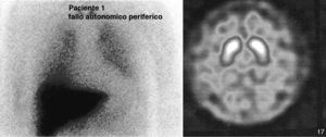 Pruebas de medicina nuclear en el primer caso, a la izquierda en la SPECT-MIBG cardiaca se observa una importante hipocaptación cardiaca. En la derecha figura el SPECT 123-I-FP-CIT (DAT-SCAN) que es normal.