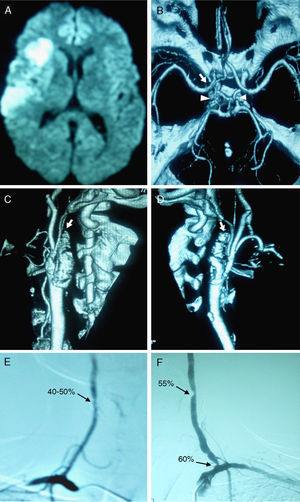 A) RM de difusión que muestra una lesión isquémica aguda en el territorio de la arteria cerebral media derecha. B) Angio-TC de polígono de Willis que muestra un buen relleno de los vasos intracraneales, con arterias comunicantes posteriores tortuosas pero permeables (cabeza de flecha), con relleno retrógrado de sifón carotídeo derecho y casi sin relleno de sifón izquierdo (flecha). C) y D) Angio-TC de arterias cerebrales extracraneales que muestra la oclusión de la arteria carótida interna derecha (C) e izquierda (D) (flechas). E) Arteriografía de arterias vertebrales que muestra una estenosis del 40-50% en el tercio distal de la arteria vertebral derecha. F) Se observa una estenosis del 60% en el origen de la arteria vertebral izquierda, con una estenosis del 55% en el trayecto cervical distal de ésta.