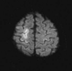 RM cerebral realizada 72 h desde el inicio de los síntomas. DWI: áreas corticales con restricción de la difusión con forma serpiginosa sugestivas de infarto venoso reciente.