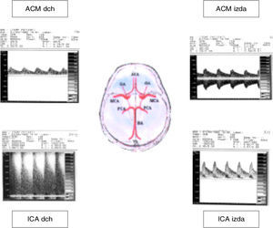 Doppler TC: asimetría en velocidad en aa. cerebrales medias, morfología postestenótica en lado derecho.