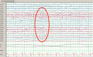 EEG: descargas paroxísticas de ondas agudas a 6Hz hemisféricas derechas coincidiendo con los clonismos en MSI.