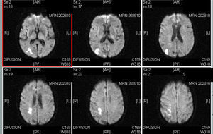 IRM craneal (difusión): lesión isquémica subaguda en territorio posterior de la ACMD, con afectación de corteza parietooccipital y de la SB periatrial.
