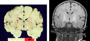 Imagen macroscópica del cerebro con pigmentación amarilla de los núcleos pálidos (Obs. 3). RM coronal T2-FLAIR de la misma observación.