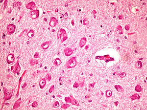 Microscopia óptica (núcleo pálido) (Obs. 3). Cambios degenerativos neuronales que muestran pérdida neuronal y astrocitosis.