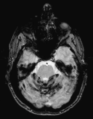 Resonancia magnética cerebral. Marcada hipointensidad lineal que tapiza la superficie del vermis superior y hemisferios cerebelosos en una secuencia T2 GE muy sensible al efecto de susceptibilidad magnética de la hemosiderina.