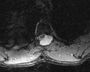 Resonancia magnética medular. Laminectomía T4-T5 y seudomeningocele posterolateral izquierdo que desplaza el cordón medular. La secuencia T2 GE muestra un fino halo hipointenso de hemosiderina alrededor del cordón medular.