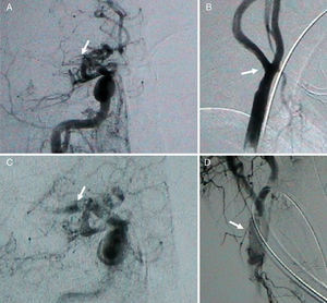 Arteriografía. La imagen A muestra el territorio intracraneal anterior, donde se aprecia una ausencia de flujo en toda la arteria cerebral media derecha (ACMD) y sus ramas (flecha). La imagen B muestra la arteria carótida interna cervical y la bifurcación carotídea derecha con signos de trombo mural (flecha). La imagen C muestra la ACMD tras realizar trombectomía con el dispositivo MERCI. Ahora la porción M1 de la ACMD es visible (flecha). La imagen D muestra el stent colocado en la bifurcación carotídeo derecha (flecha).