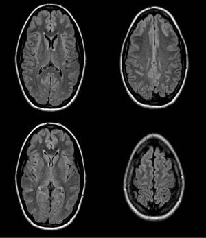 Resonancia magnética (FLAIR) que muestra hiperintensidad de surcos de la convexidad en regiones frontales y occipitales parasagitales.