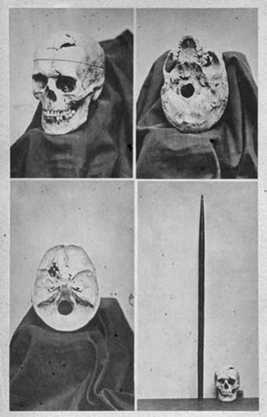 Fotomontaje que muestra cuatro vistas del cráneo de Phineas Gage (catálogo descriptivo del Warren Anatomical Museum, 187016).