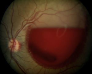 Hemorragia subhialoidea de grandes dimensiones en el ojo izquierdo tras la exploración de fondo de ojo.