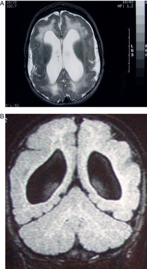 Caso 4. Paciente de 5 meses con citomegalia intrauterina. Estudio de RM. A) El corte axial en T2 muestra alteraciones corticales tipos paquigiria y polimicrogiria, dilatación de los ventrículos laterales e imagen difusa de hiperseñal en la sustancia blanca de ambos hemisferios. B) Corte coronal del mismo estudio en T1 mostrando la pobreza de circunvoluciones, la gran anchura de la sustancia gris cortical (polimicrogiria) y la gran dilatación pasiva con aspecto redondeado de los ventrículos laterales.