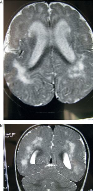 Mismo paciente de la figura 3 al año de edad. A) El corte axial muestra las mismas alteraciones corticales y subcorticales que a los 6 meses, pero las lesiones de la sustancia blanca presentan mayor grado de hiperseñal. B) El corte coronal también muestra alteraciones en la sustancia blanca similares a las de los 6 meses.