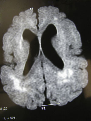 Mismo paciente de las figuras 3 y 4 a los 2 años y medio. El corte axial de la RM en T1 muestra alteraciones corticales similares a las observadas a los 6 meses y 1 años, apareciendo las zonas de hiperseñal más concentradas en diversas áreas, especialmente en las posteriores.