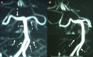 Imágenes de angio-RM en la fosa posterior (véase descripción en el texto).