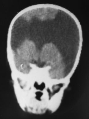 Caso 1. Imagen de TC en proyección coronal en un recién nacido. En ella se observa esquisencefalia bilateral de labios muy abiertos, con ausencia total de cuerpo calloso y de septum pellucidum.