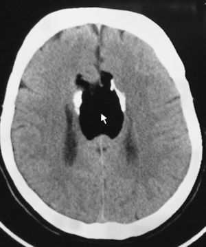 TC craneal: imagen hipodensa de 5×3cm en la localización del cuerpo calloso (flecha), que está rodeada a ambos lados por calcificación en banda. La densidad es típica de la grasa. Agenesia del cuerpo calloso.
