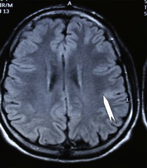 Caso 2. El corte coronal de la RM en FLAIR muestra una pequeña DCF en forma de hiperseñal cortical (punta de flecha) en zona rolándica izquierda.