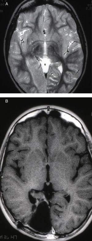 Caso 4. Corte axial de la RM mostrando una zona displásica en región occipital parasagital derecha antes (A) y después (B) de la resección quirúrgica.