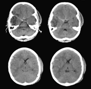 TC cerebral prequirúrgico en el cual se evidencia un crecimiento de la contusión y una compresión parcial de la cisterna ambiens derecha.