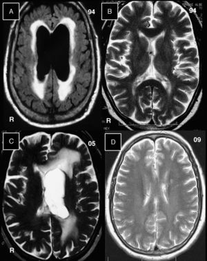 Imágenes de resonancia magnética cerebral sin la administración de gadolinio. A) Correspondiente al año 1994, en tiempo FLAIR aparece dilatación ventricular bilateral con hiperintensidades que rodean a las cavidades. B) La imagen en T2 se efectuó un mes después de la figura 1 y con la derivación ventrículo-auricular ya efectuada. Las cavidades ventriculares se normalizaron. C) Correspondiente al año 2005, en tiempo T2, muestra en el hemisferio cerebral izquierdo dilatación del ventrículo lateral, con hiperintensidades que rodean a este ventrículo. D) Correspondiente al año 2009, en tiempo T2, y no muestran alteraciones en el parénquima cerebral, y los ventrículos laterales son de tamaño normal.
