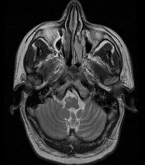 Imagen RM axial potenciada en T2. Se observa hiperintensidad en la región anterolateral derecha de bulbo raquídeo que aumenta el volumen y remodela el contorno del mismo.