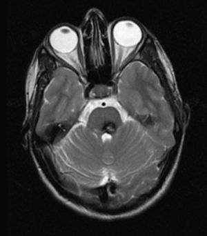 Imagen RM axial potenciada en T2. Cavernoma en hemiprotuberancia dorsomedial izquierda. Halo hipointenso y zona central hiperintensa en T2.