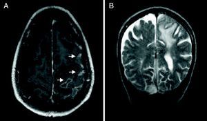 A. Afectación leptomeníngea. B. Edema subcortical. RM-secuencia T2 con contraste.