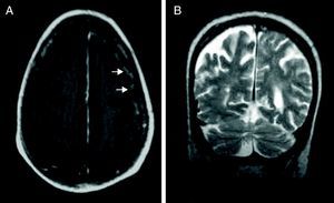 A. Menor afectación leptomeníngea. B. Ausencia de edema. RM-secuencia T2 con contraste después de corticoterapia.