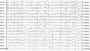EEG de vigilia muestra un foco irritativo profundo temporal izquierdo dentro de un registro de base normal en paciente con psicosis preictal.