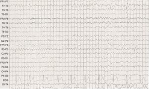 EEG de vigilia en el que se observan brotes de actividad irregular a 2-4Hz sobre la región temporal izquierda y ondas agudas sobre la región temporal media izquierda en paciente con psicosis postictal.