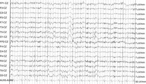 EEG de vigilia intercrítico; se observa un trazado inestable levemente lentificado con algunos brotes más lentos generalizados en paciente con psicosis postictal.