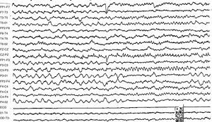 Registro EEG de vigilia en el que se aprecian brotes de puntas y polipunta de elevado voltaje sobre la región temporal posterior izquierda en paciente con ganglioglioma cerebral, previa intervención y desarrollo de psicosis por normalización forzada.