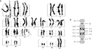 A. Cariotipo bandeo G que muestra cromosoma extra derivado de 15 (flecha); B. Ideograma del cromosoma adicional, especificando puntos de corte.