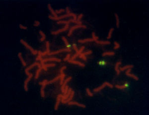FISH con sonda centromérica para el cromosoma 15 en núcleos de metafase; se observan dos señales verdes en el cromosoma derivado y una en cada centrómero de los cromosomas 15 normales.