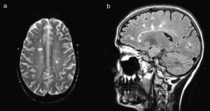 RMN craneal. Secuencias potenciadas en T2 axial (a) y FLAIR sagital (b) en las que se observa la presencia de múltiples lesiones hiperintensas en sustancia blanca supratentorial.