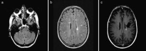 Se repitió la RMN craneal a los cuatro meses. Secuencias FLAIR axial (a y b) y secuencia potenciada en T1 axial con administración de gadolinio (c), donde se evidencia la aparición de nuevas lesiones no observadas previamente, algunas de ellas con realce en anillo con el gadolinio (flecha).